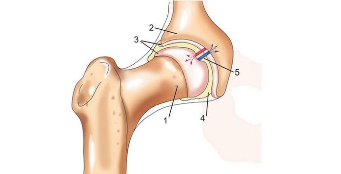 Άρθρωση ισχίου και οστεοαρθρίτιδα